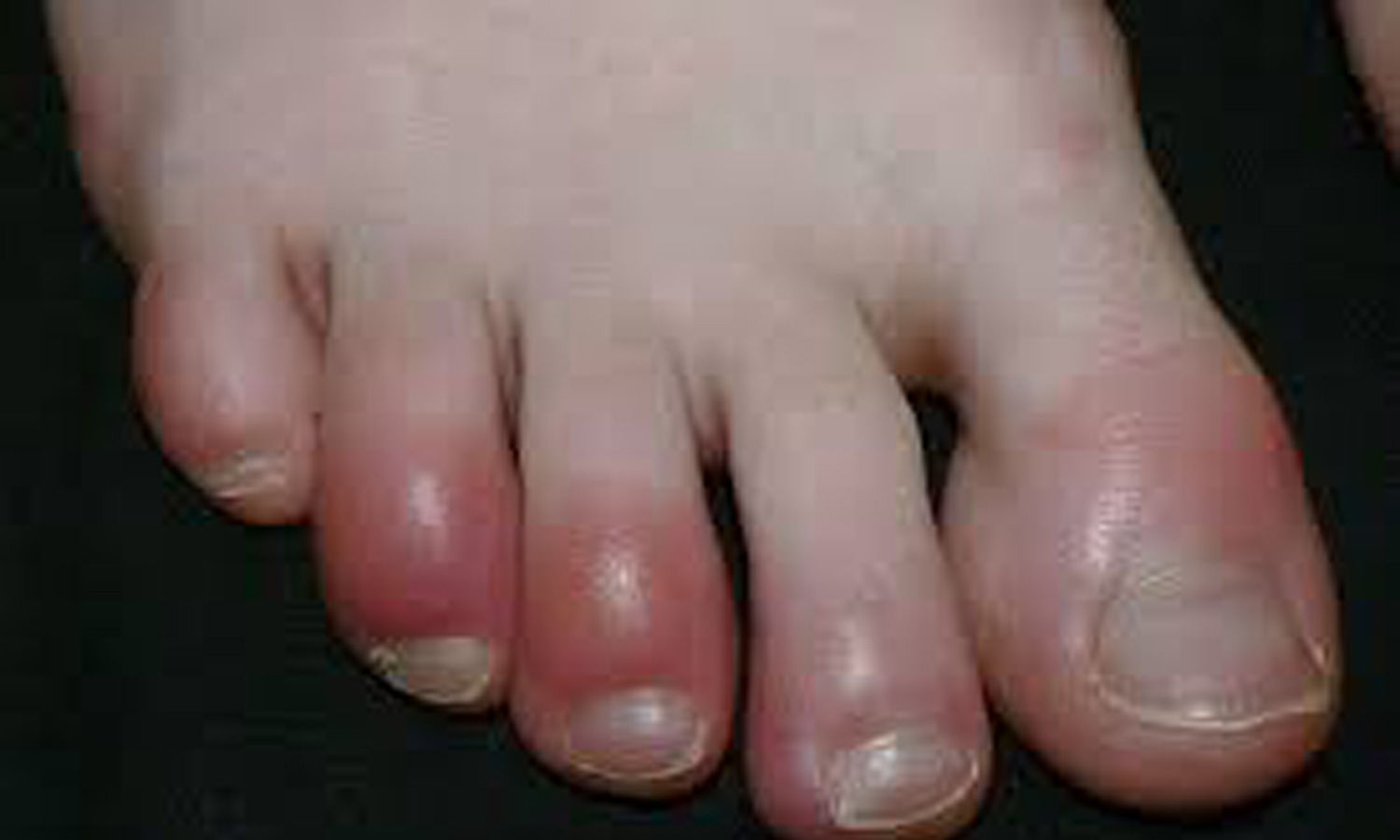 قرمزی-پا-در-کووید19