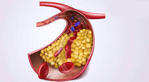 درمان-کلسترول-بالا